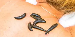 Лечение медицинскими пиявками